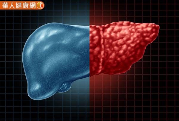 若患有非酒精性脂肪肝炎，表示除了肝脂肪變性之外，肝細胞也已經受到損傷，之後可能演變成肝硬化、肝衰竭甚至惡化成肝癌。