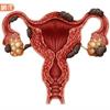10種常見子宮、卵巢病變前兆為何？如何治療？婦產科名醫潘俊亨解說一次看懂