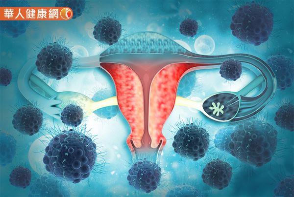 10種常見子宮、卵巢病變前兆為何？如何治療？婦產科名醫潘俊亨解說一次看懂 | 華人健康網