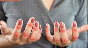 「全身性紅斑狼瘡」好發於年輕女性！醫師：5原則幫助有效控制