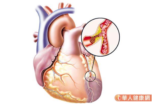 心肌梗塞的發生，是突然在一瞬間整個血流斷掉就沒有了，大概阻塞到70%以後，就會有症狀了，而急性心肌梗塞是突然完全血管被塞死。