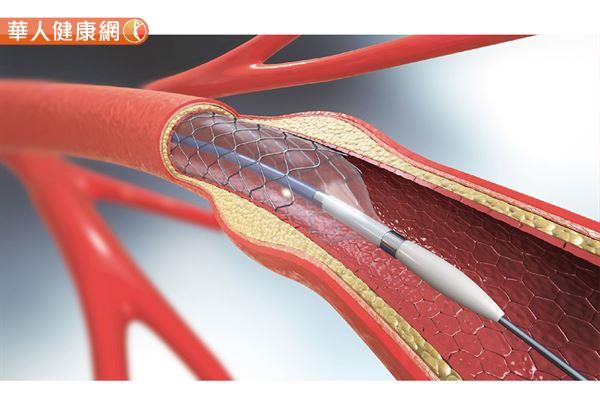 放心臟支架的目的很簡單，就是當血管透過汽球擴張術把血管撐開後，有些血管撐開後，可能內皮受傷又崩塌，等於沒有支撐的力量，會使血管容易再塞住，此時就需要使用心臟支架，把血管撐開來，這就是金屬支架的作用。