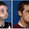 臉部移植6個月後　男重獲第二張臉
