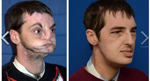臉部移植6個月後　男重獲第二張臉