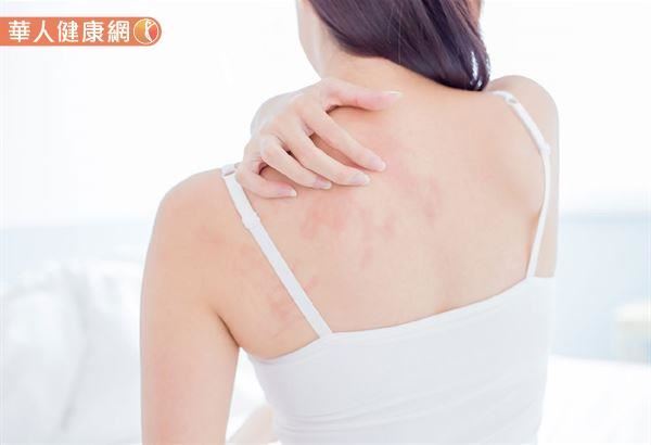 冬季易導致皮膚乾燥，輕則引發搔癢感，嚴重時會造成濕疹或是異位性皮膚炎發作。陳家駿醫師提醒家長，應使用乳液至少一天兩次以上，加強皮膚的保濕，可以有效降低搔癢或濕疹的狀況。