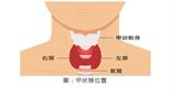 《懶人包》甲狀腺結節，真的要開刀嗎？必知「甲狀腺消融治療三劍客」