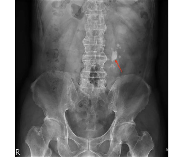 患者有多顆且大量的左側腎結石。（圖片提供／安南醫院）