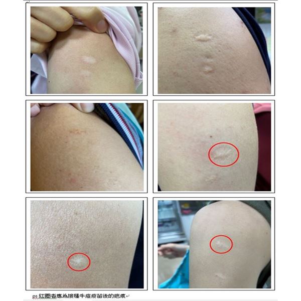 紅圈標示為接種牛痘疫苗後的疤痕。（圖片提供／茂盛醫院）