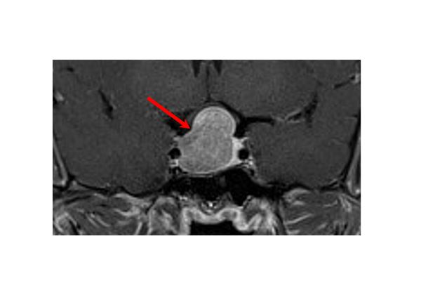 MRI看到紅色箭頭標示處即為腦下垂體腫瘤。（圖片提供／馬偕醫院）