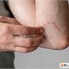每年37萬異位性皮膚炎患者就醫！精準抗「異」，穩控異位性皮膚炎