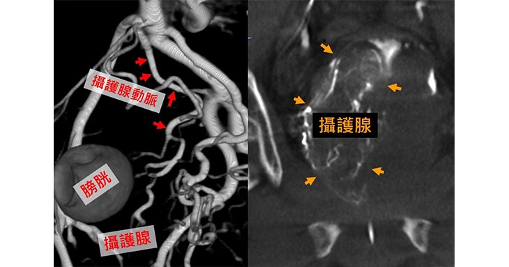 圖二,術中使用錐狀束電腦斷層(CBCT)進行3D精準導引,可大幅提高治療。(圖片提供/中山醫學大學附設醫院)