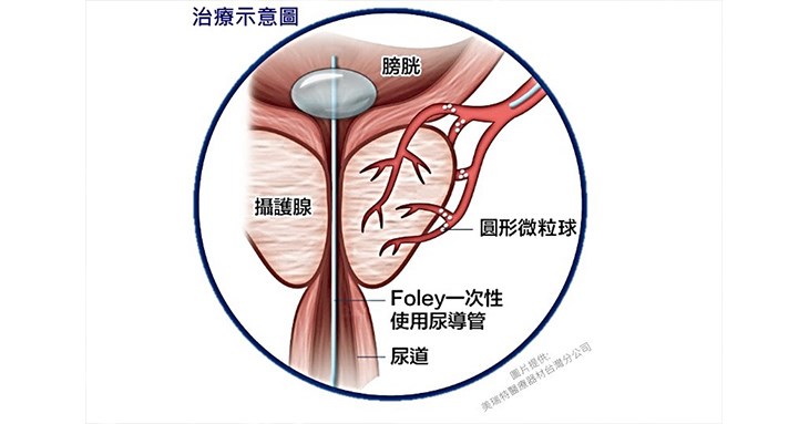 圖三,將微細導管置入攝護腺動脈後注入微球阻斷血流。(圖片提供/中山醫學大學附設醫院)