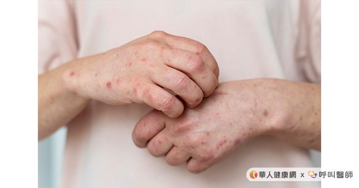 長輩在冬季的皮膚特別容易覺得乾癢，小心是冬季「缺脂性皮膚炎」找上門！