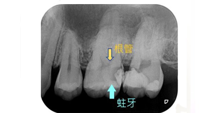 牙齒因蛀牙需根管治療示意圖（圖片提供／亞東醫院）