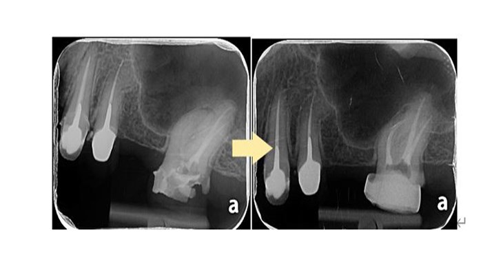 左圖的大臼齒雖然做過根管治療，但是病灶未消，所以只能藉由顯微鏡的輔助，重新再次根管治療 (右圖)（圖片提供／亞東醫院）