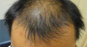 天冷雄性禿患者增多　治療前先評估