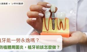 植牙能一勞永逸嗎？預防植體周圍炎，植牙前該怎麼做？