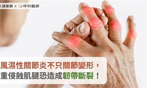 類風濕性關節炎不只關節變形，嚴重侵蝕肌腱恐造成韌帶斷裂！