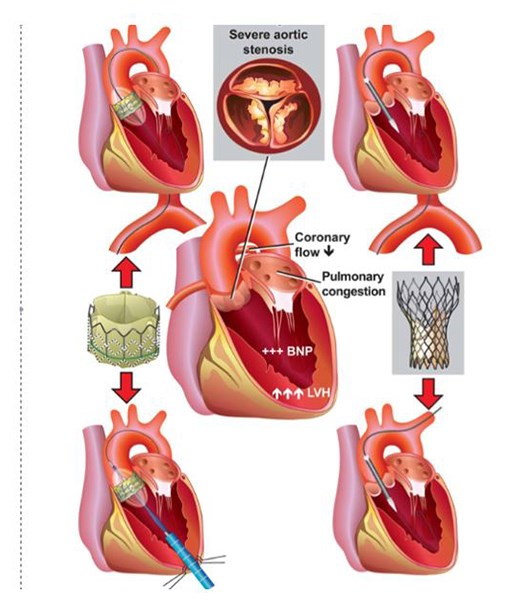經導管主動脈瓣膜置換術示意圖（圖片提供／亞東醫院）