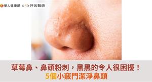 草莓鼻、鼻頭粉刺，黑黑的令人很困擾！5個小竅門潔淨鼻頭