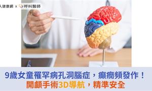 9歲女童罹罕病孔洞腦症，癲癇頻發！開顱手術3D導航，精準安全