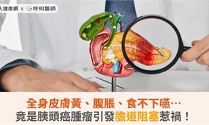 全身皮膚黃、腹脹、食不下嚥…竟是胰頭癌腫瘤引發膽道阻塞惹禍！