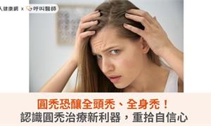 圓禿恐釀全頭禿、全身禿！認識圓禿治療新利器，重拾自信心