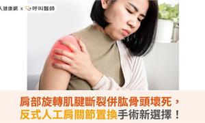 肩部旋轉肌腱斷裂併肱骨頭壞死，反式人工肩關節置換手術新選擇！