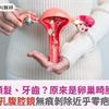 腫瘤竟藏頭髮、牙齒？原來是卵巢畸胎瘤作怪！單孔腹腔鏡無痕剝除近乎零疤痕