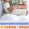 AI幫助判別骨折的新舊狀態！提升CT影像診斷效能，避免誤診或延誤