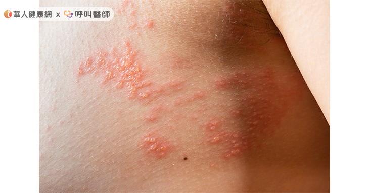 研究顯示,慢性腎臟病患者的帶狀疱疹風險比一般族群增加1.29倍。