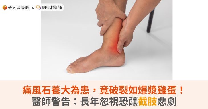 痛風石養大為患,竟破裂如爆漿雞蛋!醫師警告:長年忽視恐釀截肢悲劇