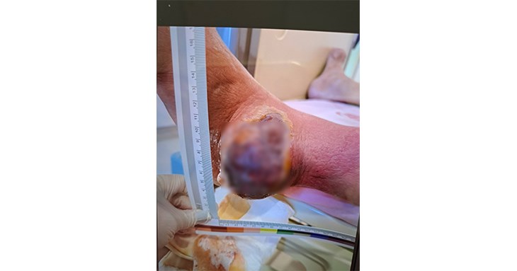 1名62歲黃男竟出現雞蛋般大的痛風石破裂,外觀宛如「爆漿」。(圖片提供/亞大醫院)