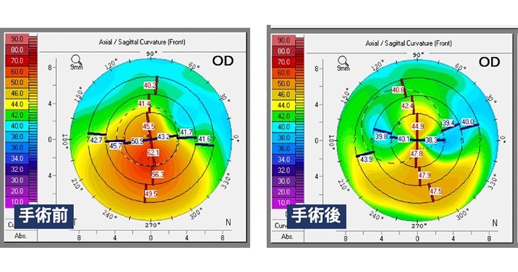 張小姐手術前及手術後角膜地形圖對照(圖片提供/基隆長庚醫院)
