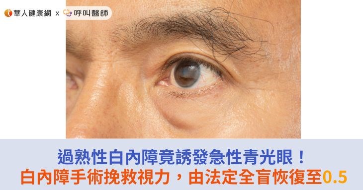過熟性白內障竟誘發急性青光眼!白內障手術挽救視力,由法定全盲恢復至0.5