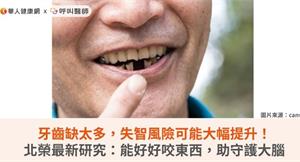 牙齒缺太多，失智風險可能大幅提升！北榮最新研究：能好好咬東西，助守護大腦