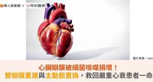 心臟瓣膜被細菌啃噬損壞！雙瓣膜重建與主動脈置換，搶救嚴重心衰患者一命 