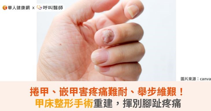 捲甲、嵌甲害疼痛難耐、舉步維艱!甲床整形手術重建,揮別腳趾疼痛