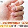 捲甲、嵌甲害疼痛難耐、舉步維艱！甲床整形手術重建，揮別腳趾疼痛