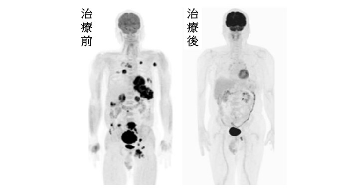 治療前身體內各大黑點為末期黑色素癌腫瘤(左圖);經「免疫檢查點抑制劑治療」治療後,末期黑色素癌腫瘤逐漸消失(右圖)。(圖片提供/仁愛長庚合作聯盟醫院)