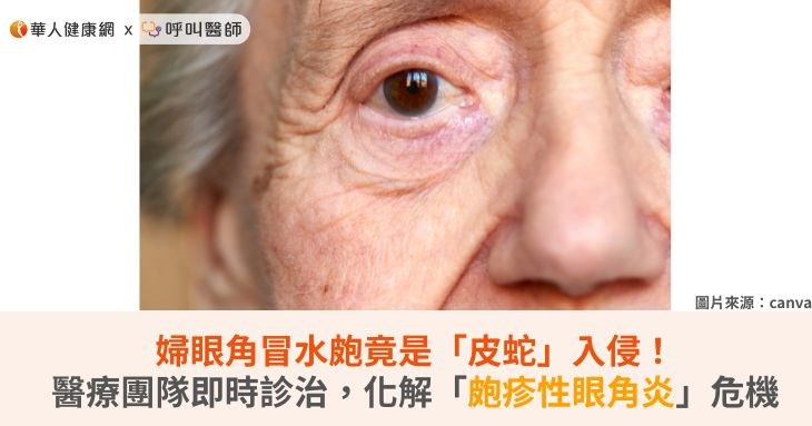 婦眼角冒水皰竟是「皮蛇」入侵!醫療團隊即時診治,化解「皰疹性眼角炎」危機