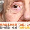 婦眼角冒水皰竟是「皮蛇」入侵！醫療團隊即時診治，化解「皰疹性眼角炎」危機          