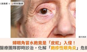 婦眼角冒水皰竟是「皮蛇」入侵！醫療團隊即時診治，化解「皰疹性眼角炎」危機          
