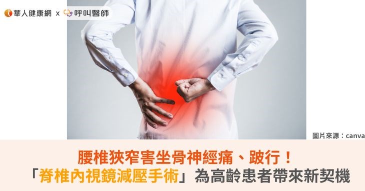 腰椎狹窄害坐骨神經痛、跛行!「脊椎內視鏡減壓手術」為高齡患者帶來新契機