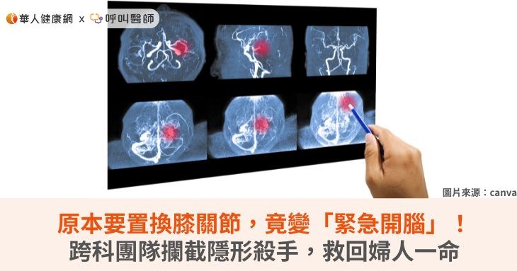 原本要置換膝關節,竟變「緊急開腦」!跨科團隊攔截隱形殺手,救回婦人一命