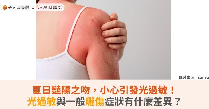 夏日豔陽之吻,小心引發光過敏!光過敏與一般曬傷症狀有什麼差異?