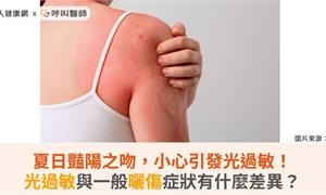 夏日豔陽之吻,小心引發光過敏!光過敏與一般曬傷症狀有什麼差異?