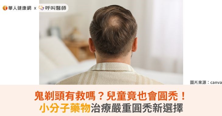 鬼剃頭有救嗎?兒童竟也會圓禿!小分子藥物治療嚴重圓禿新選擇