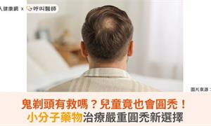 鬼剃頭有救嗎?兒童竟也會圓禿!小分子藥物治療嚴重圓禿新選擇