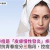 青春痘是「皮膚慢性發炎」疾病！醫揭：對抗青春痘分三階段，控痘等同防疤